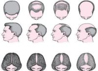 什么是雄激素性脱发？雄激素性脱发怎么治？