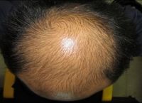 怎么防止掉发脱发生姜 - 专家教你如何预防掉发脱发