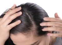 男性秃顶严重怎么办？探索有效的治疗方法和预防措施