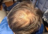 引起的脱发的原因是什么？解析脱发的常见原因及对策