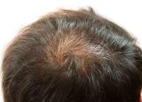 脱发严重月经不调是什么原因引起的