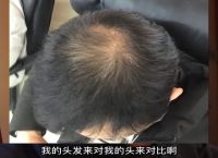 杭州一般植发要多少钱