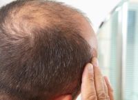 如何防止生理性脱发的发生原因有哪些？