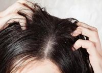 头发爱出油还脱发怎么办吃什么东西好？如何保护头皮健康卫生？