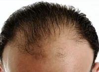 发际线脂溢性脱发怎么办？