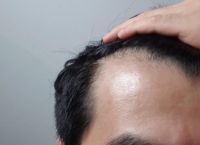 脂溢性脱发要尽早治疗吗？