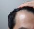 脂溢性脱发要尽早治疗吗？