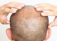 掉发很严重是什么原因造成的？吃什么有助于防脱发生发？