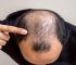 男人脂溢性脱发严重怎么办？如何预防脱发？