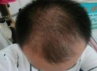 男性型脱发的原因？怎么预防脱发发生？