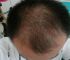 男性型脱发的原因？怎么预防脱发发生？