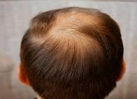 停止秃顶：如何应对因出汗而导致的脱发问题