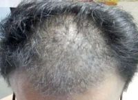 肾虚型脱发和脂溢性脱发区别（肾虚型脱发能恢复吗）