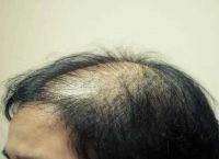 脂溢性脱发头发一个月不长的原因及应对措施