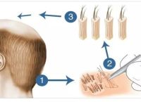 烫发引起的脱发秃顶：如何预防和处理？