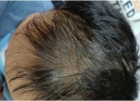 40多岁秃顶还能生发吗？专家解析秃发原因及治疗方法