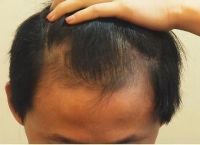 脂溢性脱发毛囊萎缩堵塞的治疗和药物推荐