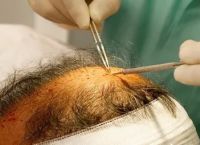 头皮头癣和脱发的原因分析及预防方法
