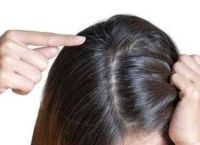 脂溢性脱发怎么办怎么治疗方法