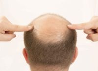 24岁<strong>秃顶怎么办</strong>？如何有效应对早发秃问题？