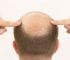 24岁秃顶怎么办？如何有效应对早发秃问题？
