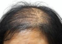 用劣质洗发水导致秃顶怎么办呢
