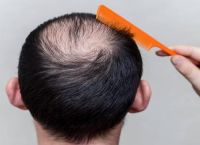秃顶想去植发又太贵怎么办？详细解读植发的优势和费用选择