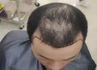 秃顶男人发型怎么办？解决秃顶困扰的有效方法