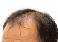 脂溢性脱发秃顶的防治方法