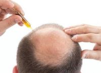 深圳脂溢性脱发的症状、原因和治疗方法