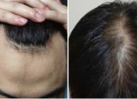 毛囊脂溢性脱发的症状、治疗和预防方法
