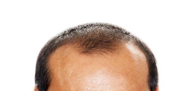 雄激素性脱发和脂溢性脱发的区别