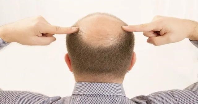 慢性脂溢性脱发还能长出来吗（男性脱发的原因有几种）