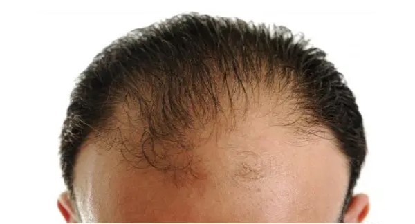 脂溢性脱发有什么症状（防止脱发的药物有哪些）