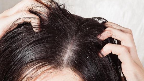 头发出油脱发严重是什么原因（头容易出油脱发怎么办）