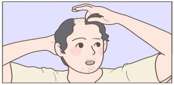 男性脱发的原因有几种（防脱发洗发水是智商税吗）