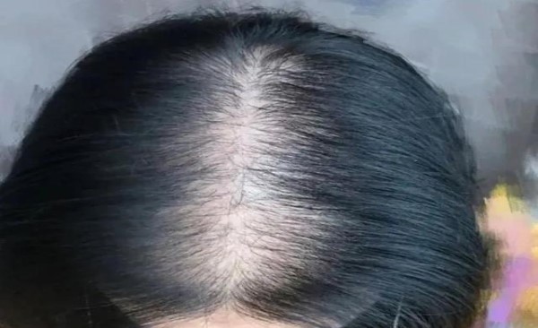 慢性脂溢性脱发还能长出来吗