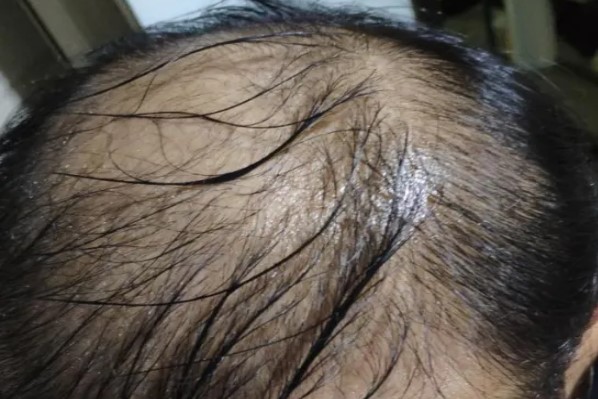 头发出油脱发主要原因是什么，头发爱出油还脱发怎么办？