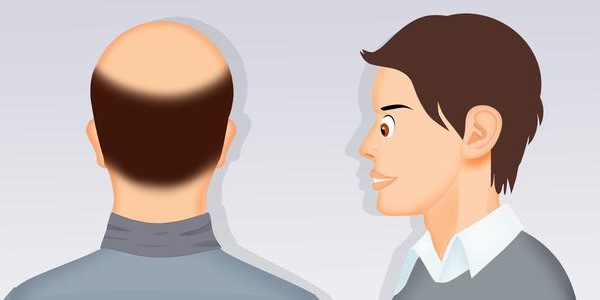 如何面对自己的秃顶，面对秃顶人们第一感觉是什么？