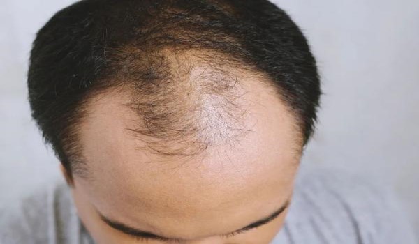秃顶会遗传给下一代吗