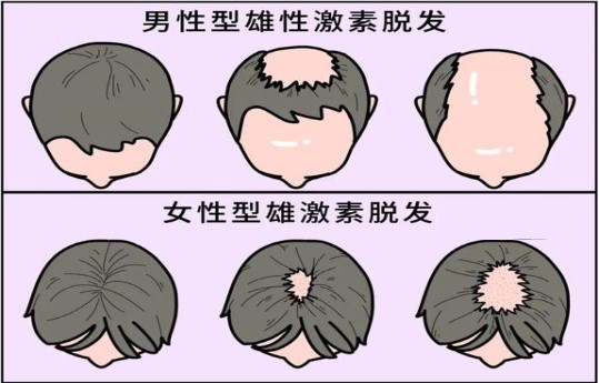 脱发的几种类型和原因，中医调理可逆转脱发！