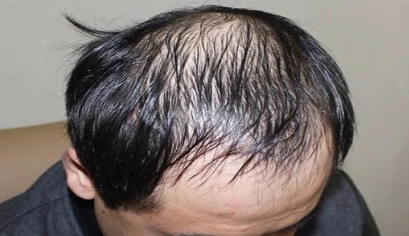 什么是脂溢性脱发