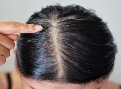 长期戴假发对身体有害吗