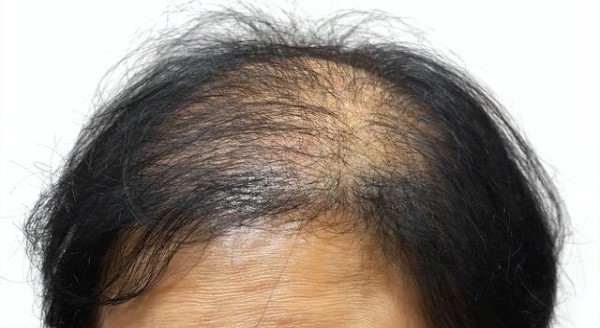 什么是雄性激素脱发