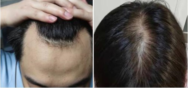 雄激素性脱发怎么治疗？