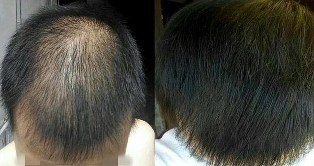 防止脱发的最好方法有哪些知乎