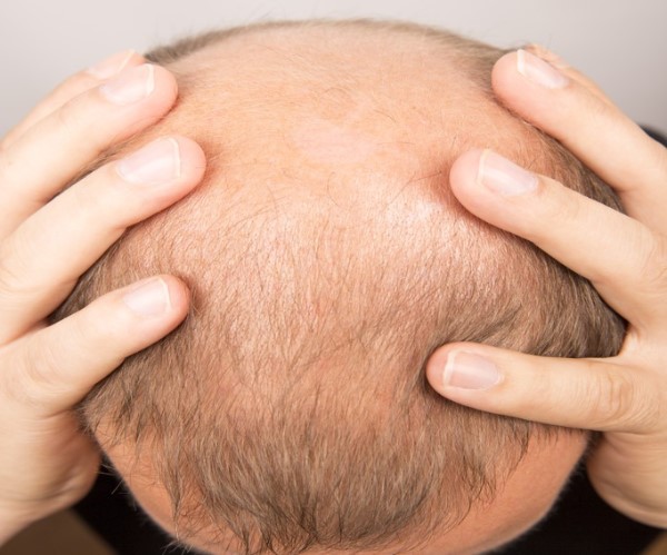 脱发严重是什么原因引起的？目前治疗脱发的方法有哪些？