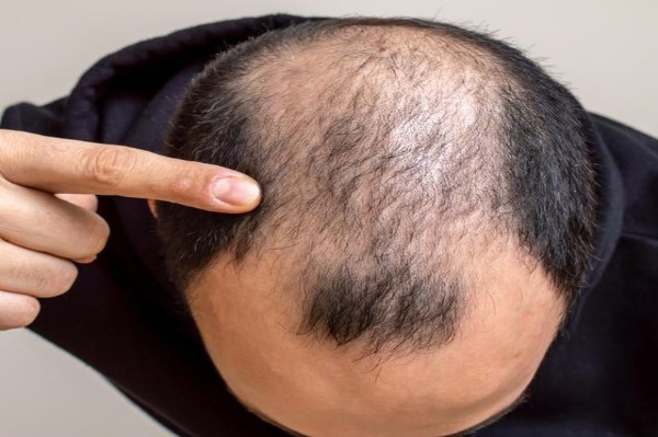 雄激素性脱发的治疗方法