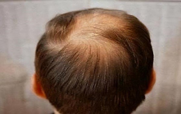 青少年脱发严重怎么办如何控制脱发？2种方法防秃顶！