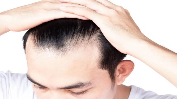 什么是脂溢性脱发？如何预防脂溢性脱发？